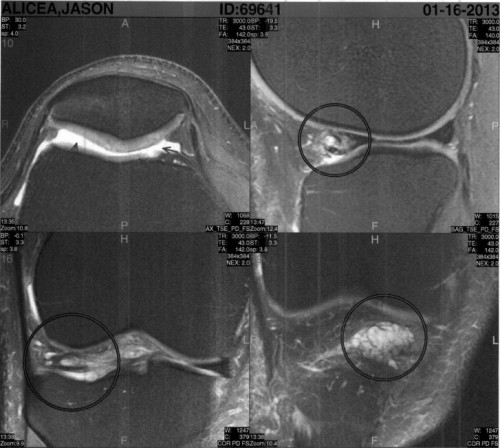 arthroscopic knee surgery 