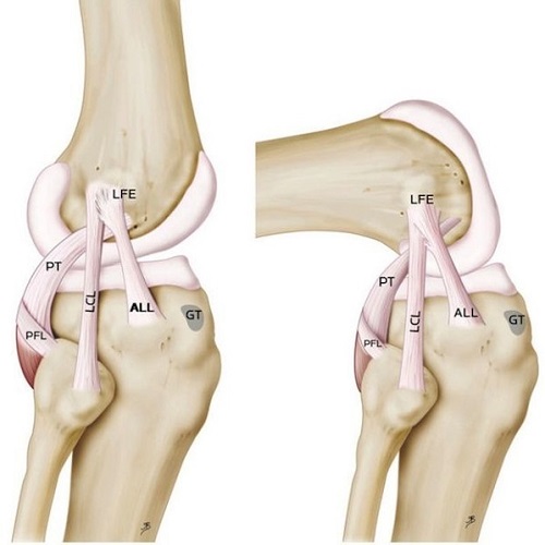 Anterolateral Ligament  A New Knee Ligament Discovered