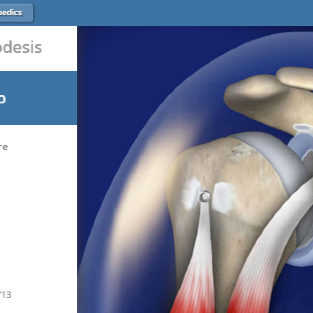 Biceps Tenodesis NYC | Manhattan Orthopedic Care