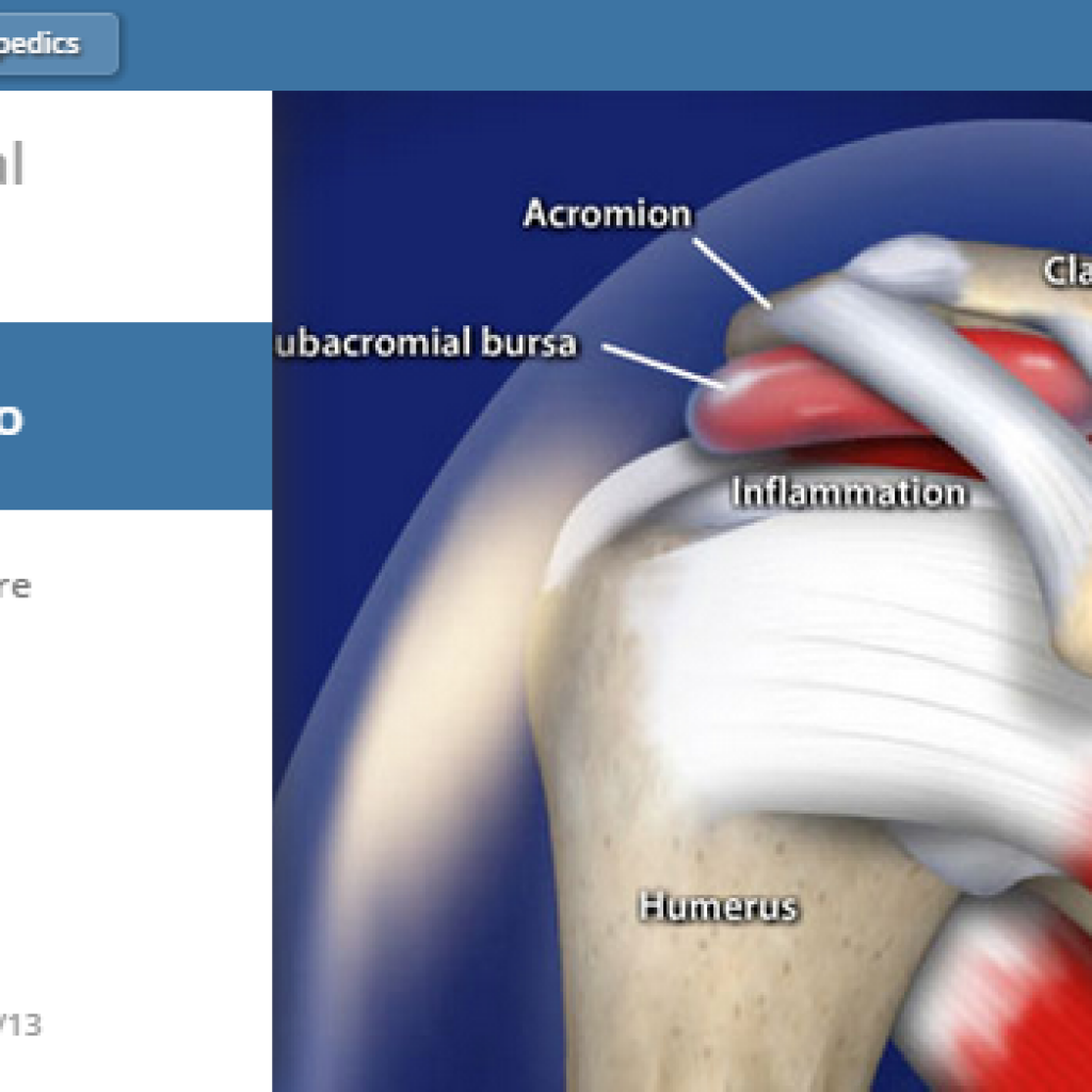 Symptoms of Bursitis Manhattan Orthopedic Care